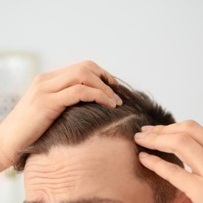 Hair Loss Treatment